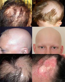 Andre typer hårtab hud og hårklinikken