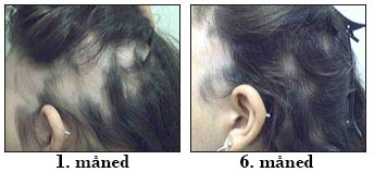 Alopecia Areata før efter